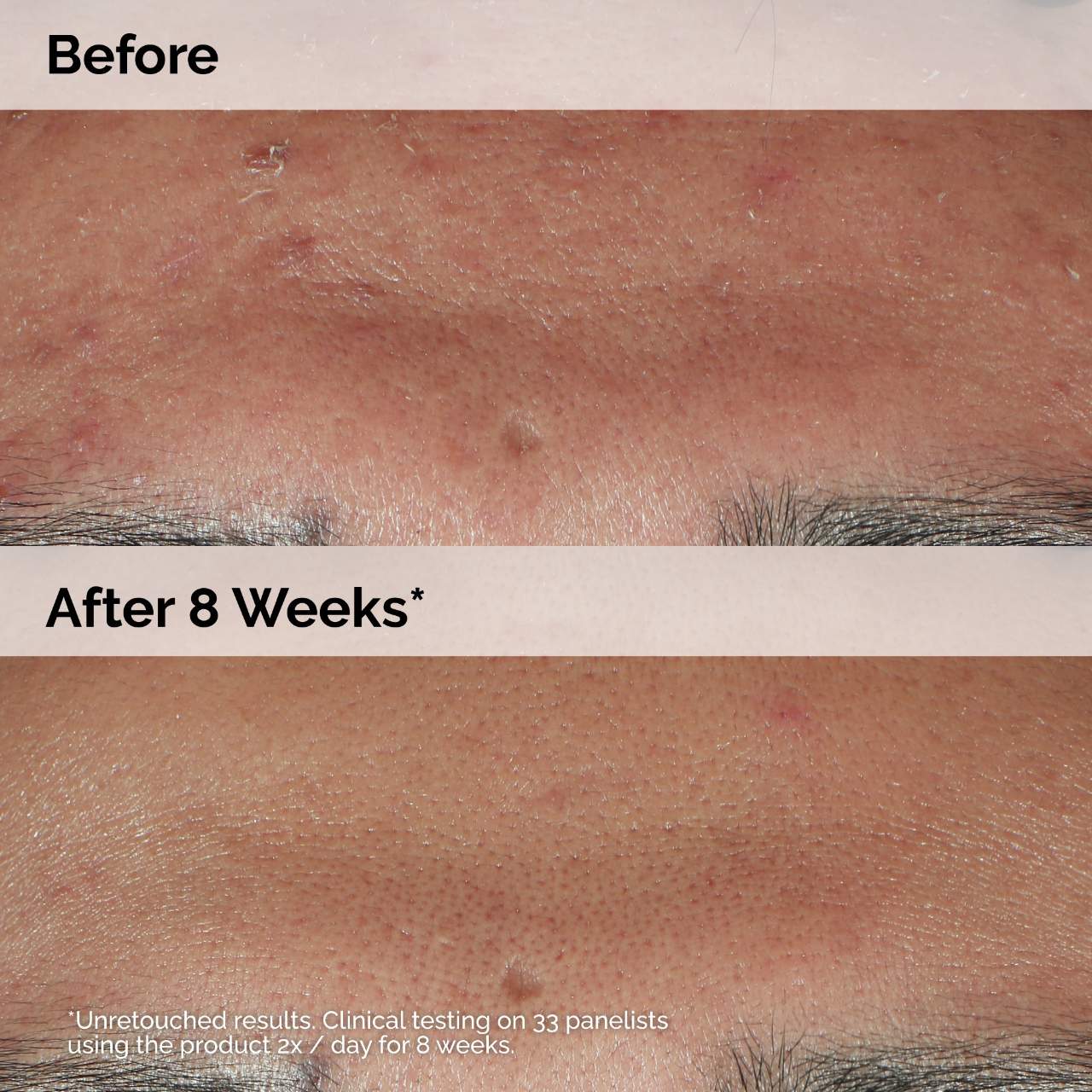 NIACINAMIDE 10% + ZINC 1% OIL CONTROL SERUM